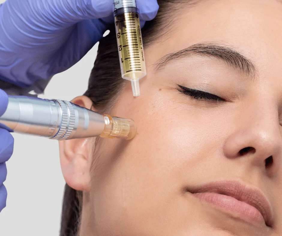 Aplicación de Plasma Rico en Plaquetas